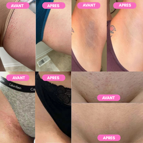 Respira™ - Rasoir & Épilateur indolore